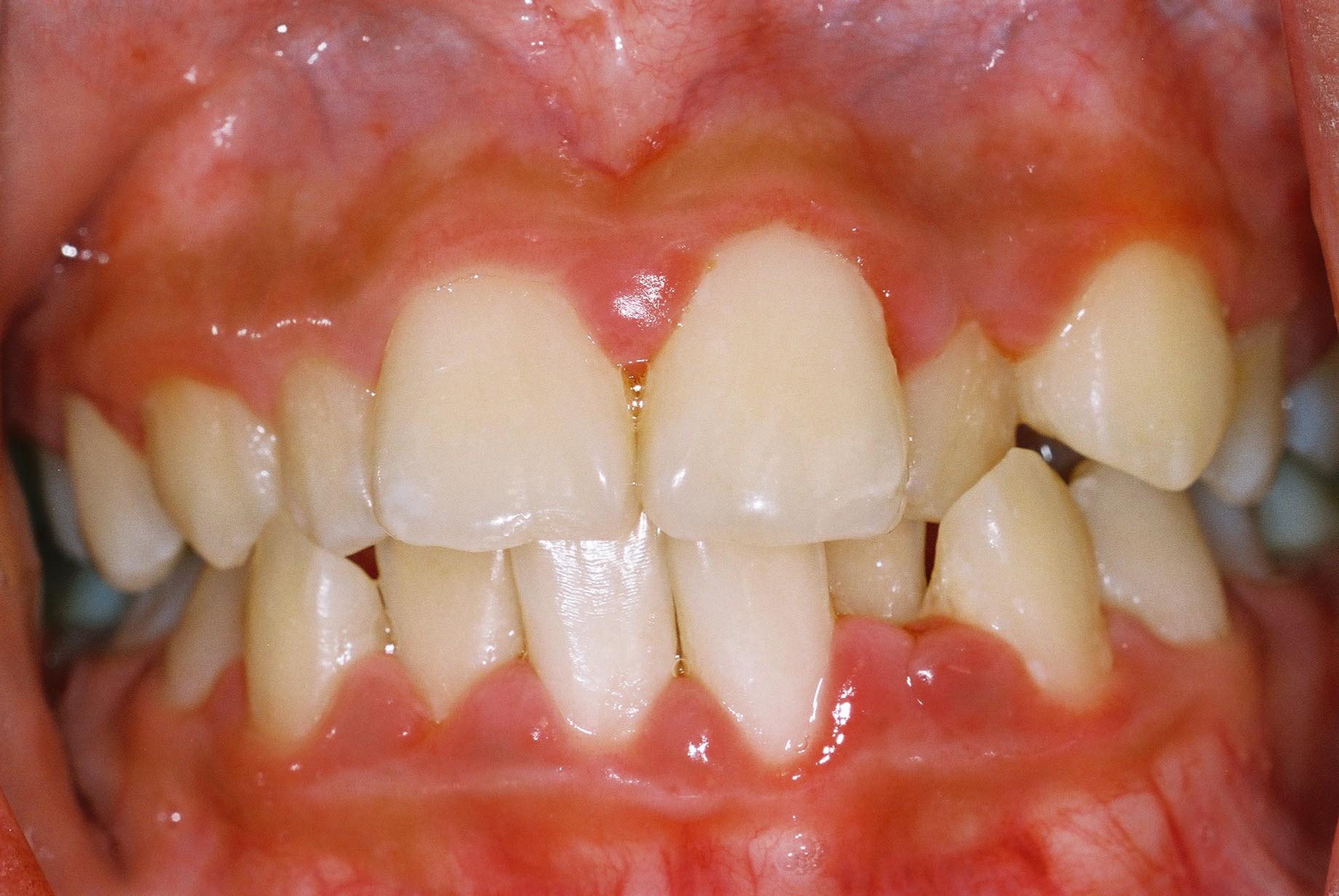 Healthy+gums+vs+gingivitis