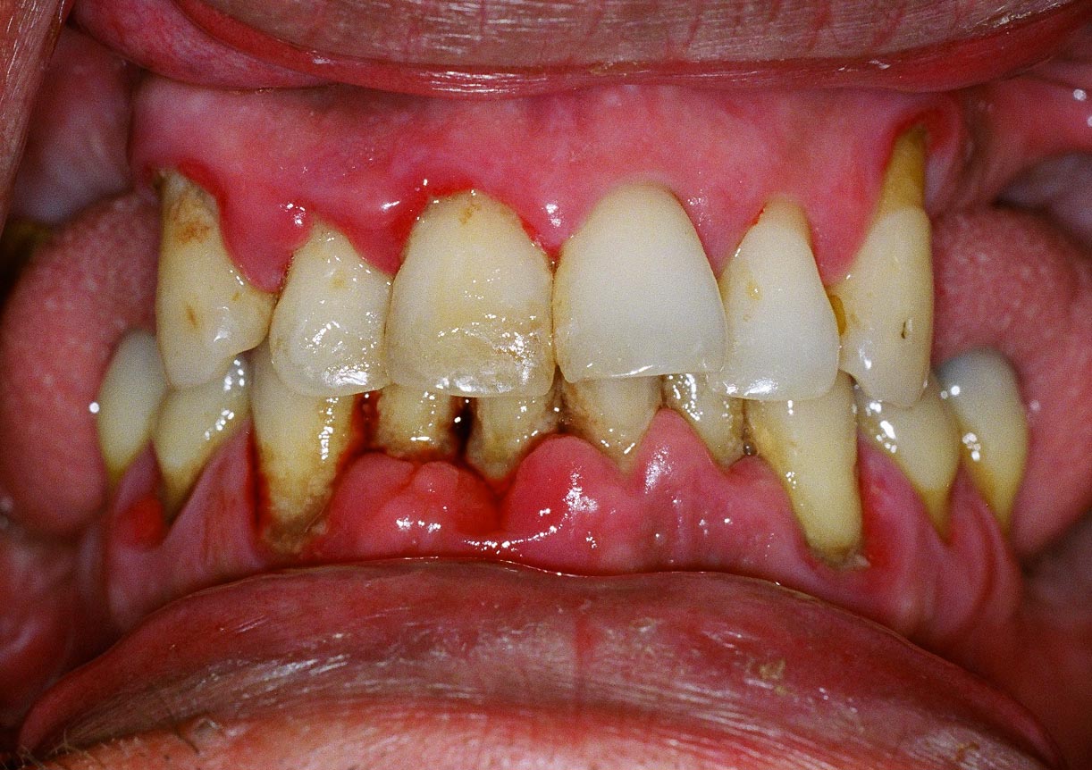 Periodontitis