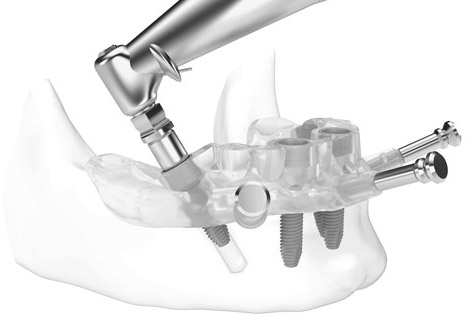 All-on-4 Procedure | Institute of Dental Implants & Periodontics