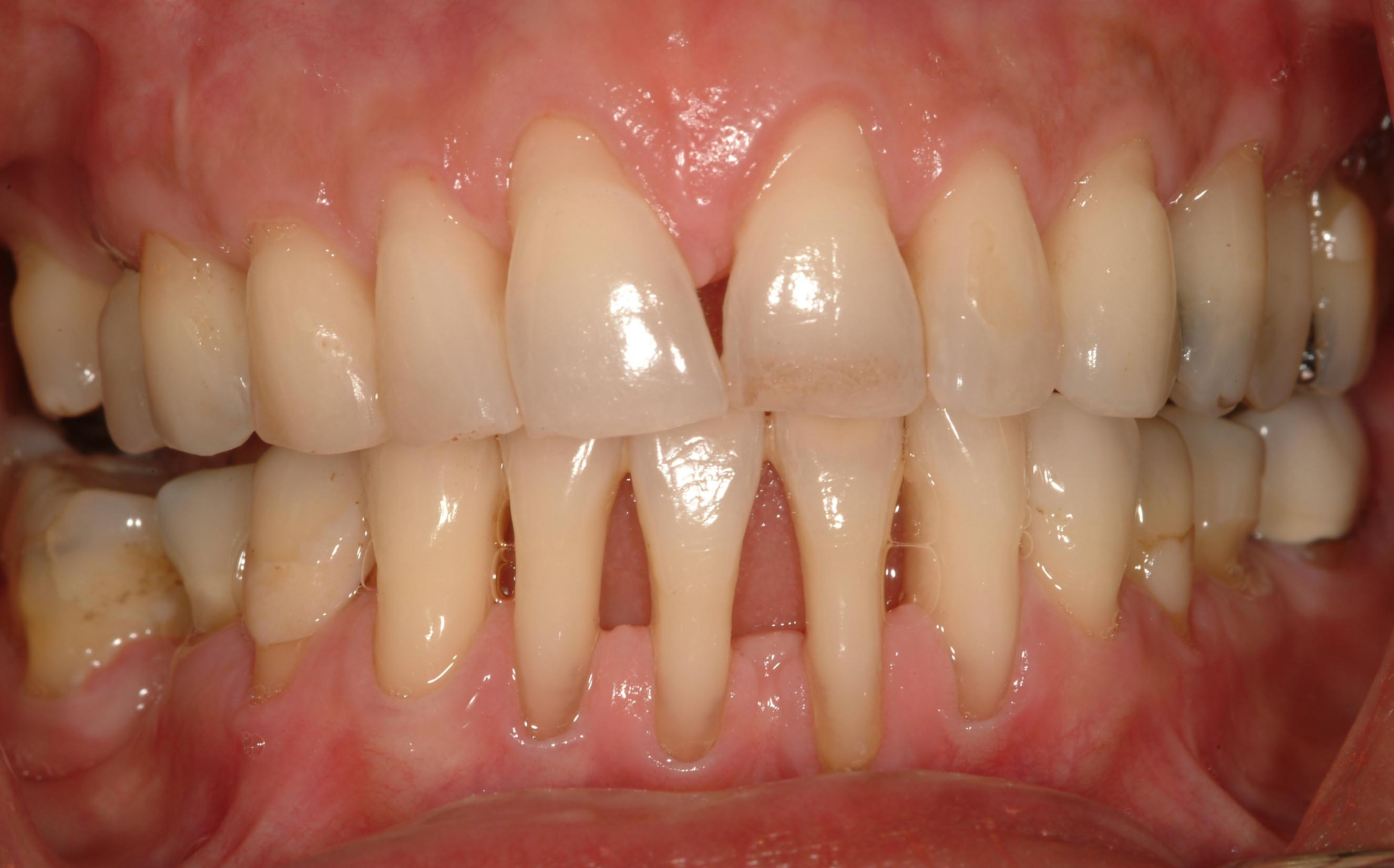 Periodontal (Gum) Disease | Institute of Dental Implants ...